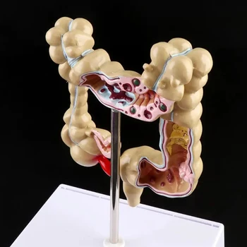 Colorectal Leziune Model De Colon Uman Șarpe Intestinului Gros Boli Patologice Modelul Medical Organizator Anatomie Picătură De Transport Maritim
